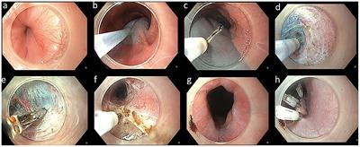 POEM Is a Durable Treatment in Children and Adolescents With Achalasia Cardia